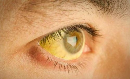 Olhos amarelados