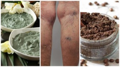 Como eliminar as varizes de forma natural com 6 remédios caseiros