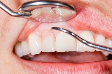 13 razões pelas quais as gengivas sangram quando você escova os dentes