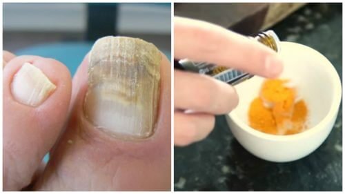 Combata os fungos nas unhas com um tratamento de cúrcuma
