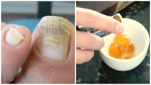 Combata os fungos nas unhas com um tratamento natural de cúrcuma Combata os fungos nas unhas com um tratamento natural de cúrcuma