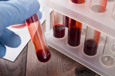 Um exame de sangue ajuda a detectar um câncer em sua fase inicial