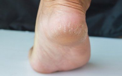 6 remédios para tratar os calcanhares rachados