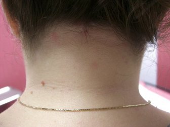 Dermatite: tipos, causas, e remédios naturais para seu tratamento