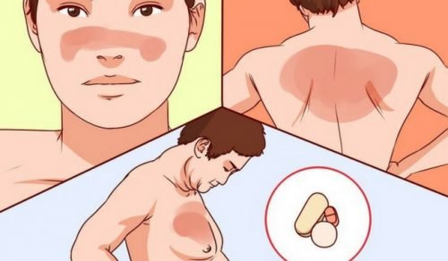 Tudo o que você deveria saber sobre o lúpus