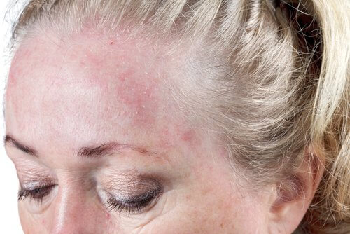 Recomendações para evitar a dermatite