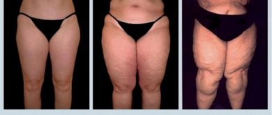 Lipedema, uma dura doença que você precisa conhecer