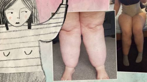 Mulheres com lipedema