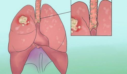 Câncer de pulmão: sinais para não ignorar