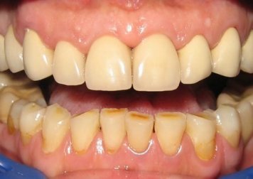 10 formas de eliminar a placa bacteriana naturalmente