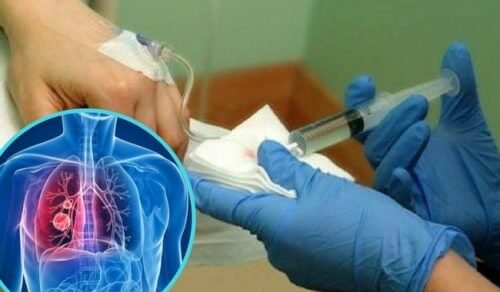Um medicamento para diminuir a quimioterapia no pulmão