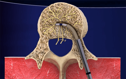 Vertebra lombar