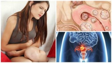5 dados sobre os miomas uterinos