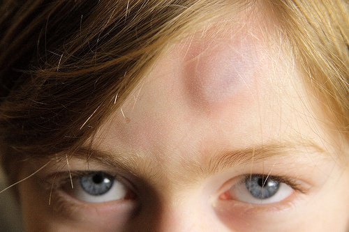 9 soluções naturais para tratar as manchas roxas
