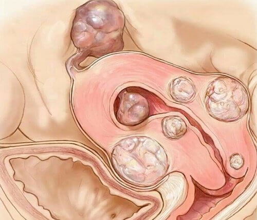 os miomas uterinos