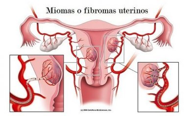 Mioma uterino: 7 sinais de alerta