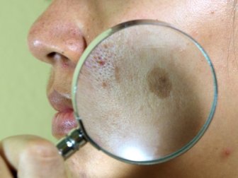 7 tratamentos naturais para o melasma