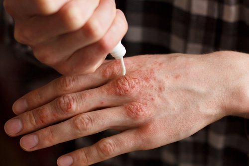 6 cremes naturais para tratar a psoríase