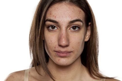 Você sabia que o Vick Vaporub pode amenizar a acne?