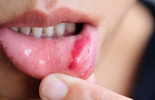 Câncer de boca: sintomas, fatores de risco e prevenção