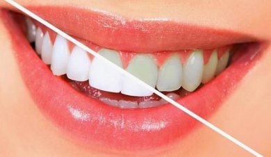 10 alimentos para clarear os dentes naturalmente