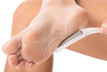 Como remover os calos de forma natural