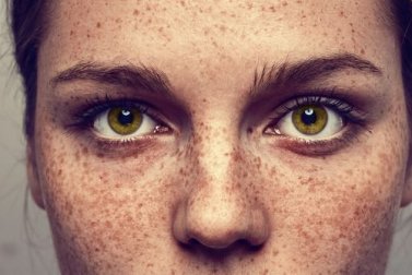 É possível remover as sardas de maneira totalmente natural