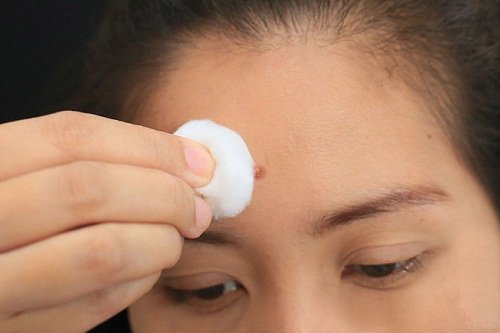 6 problemas internos que as espinhas no rosto nos indicam
