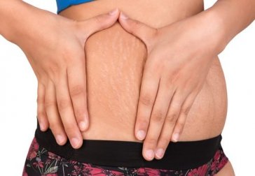 2 alternativas naturais para tratar das estrias