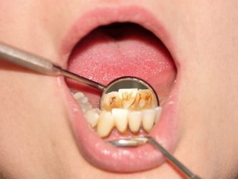 Como retirar a placa dental de forma natural