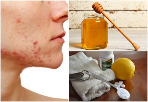6 remédios naturais para enfrentar a acne cística