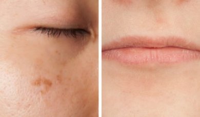 5 sintomas de deficiência de vitaminas que podem ser lidos em seu rosto