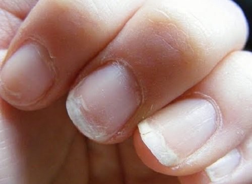 Unhas fracas podem ser um sinal de má circulação