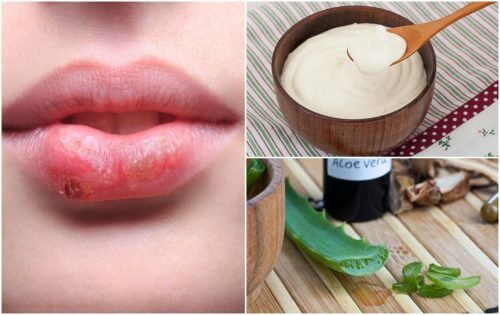 7 tratamentos naturais contra o herpes labial 7 tratamentos naturais contra o herpes labial