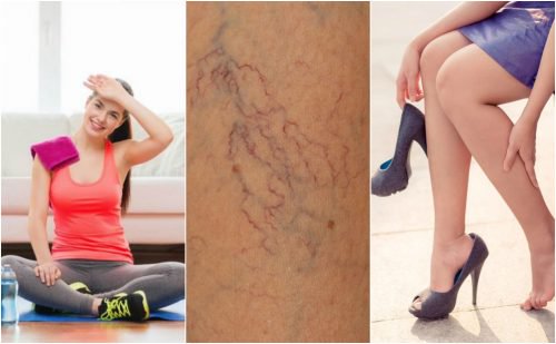 8 coisas que você pode fazer para prevenir as aranhas vasculares 8 coisas que você pode fazer para prevenir as aranhas vasculares