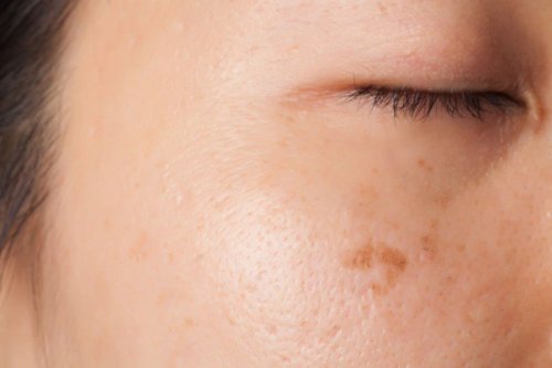Manchas na pele pode sugerir um sintoma comum de câncer