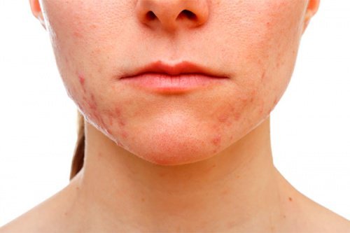 Dicas para eliminar a acne que aparece no queixo