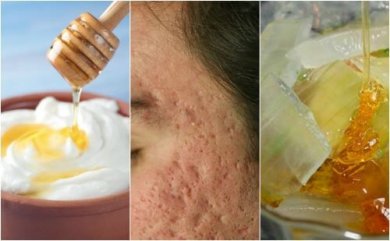 A acne deixou marcas no seu rosto? Reduza-as com estas 5 máscaras naturais