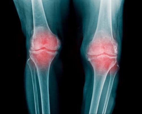 Artrose nos joelhos