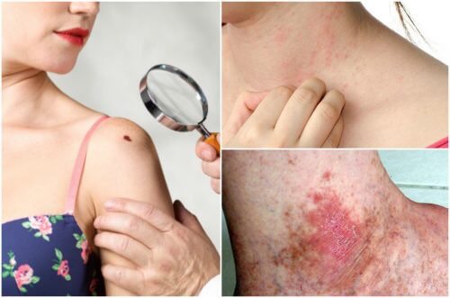 6 sintomas de câncer de pele que você não deve ignorar 6 sintomas de câncer de pele que você não deve ignorar