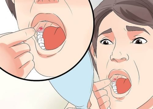 Como diminuir o inchaço depois de extrair um dente siso