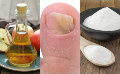 Como combater os fungos nas unhas com vinagre de maçã e bicarbonato de sódio