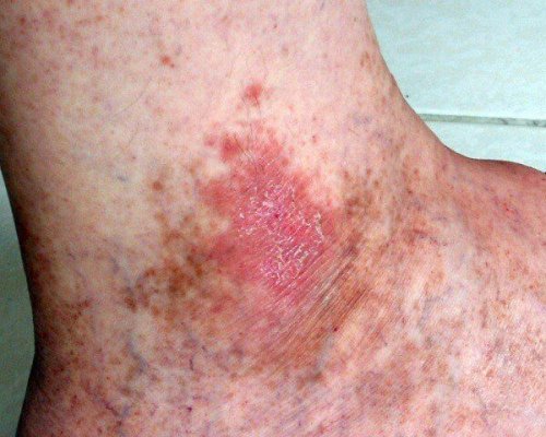 Ter feridas que não cicatrizam pode indicar um câncer de pele