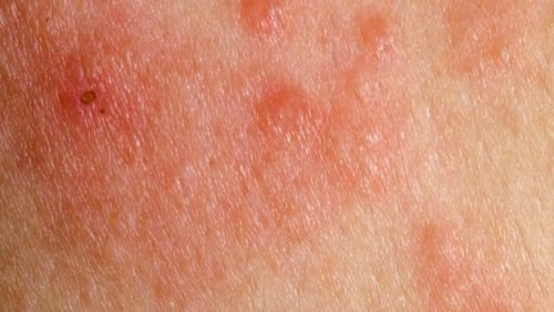 Vermelhidão pode ser um dos sintomas de câncer de pele