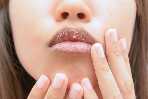 Sinal de deficiências nutricionais nos lábios