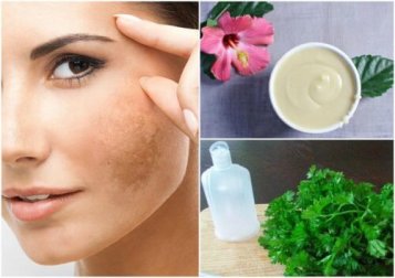 Diminua o melasma em seu rosto com 5 tratamentos naturais