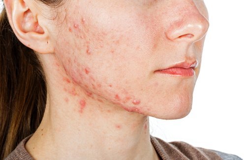 Acné é o resultado de deficiências nutricionais