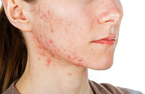 Rosto de mulher com acne