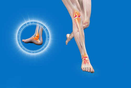 Torção: como tratar os sintomas de maneira natural
