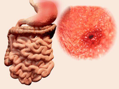 os gases intestinais